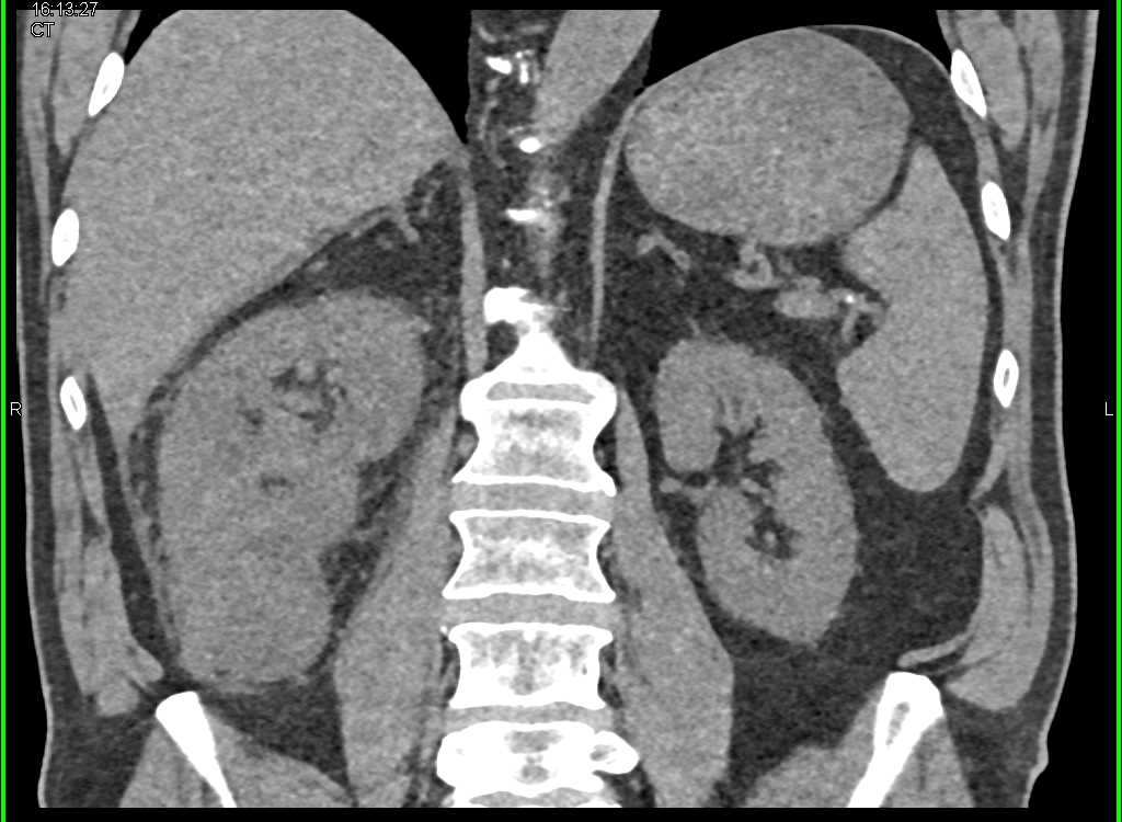 Transitional Cell Carcinoma (TCC) Right Kidney with Renal Vein Thrombus - CTisus CT Scan