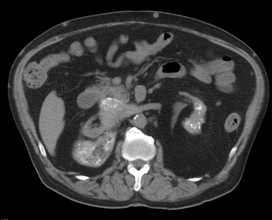 Retroperitoneal Fibrosis - CTisus CT Scan