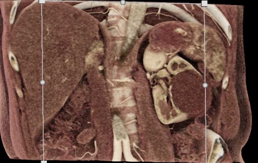 Bosniak 2 Cyst - CTisus CT Scan