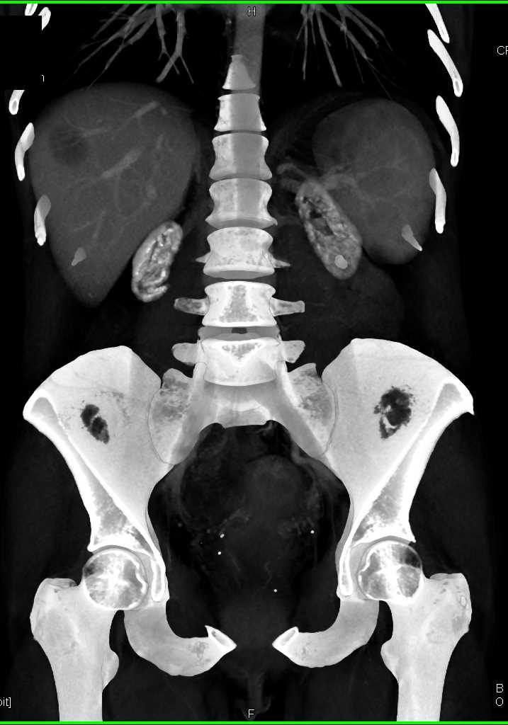 End Stage Renal Disease due to Oxalosis - CTisus CT Scan