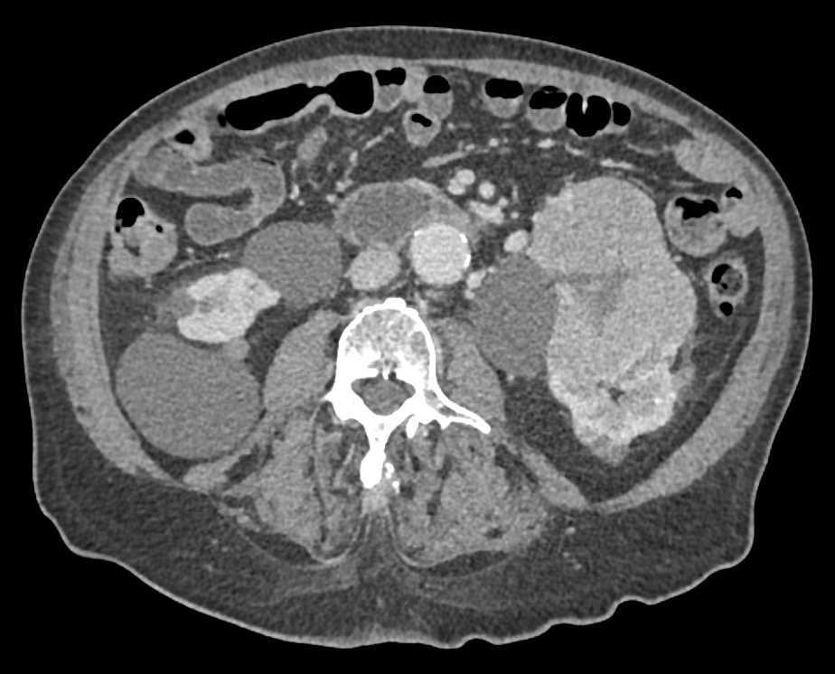 Renal Cell carcinoma Left Kidney - CTisus CT Scan