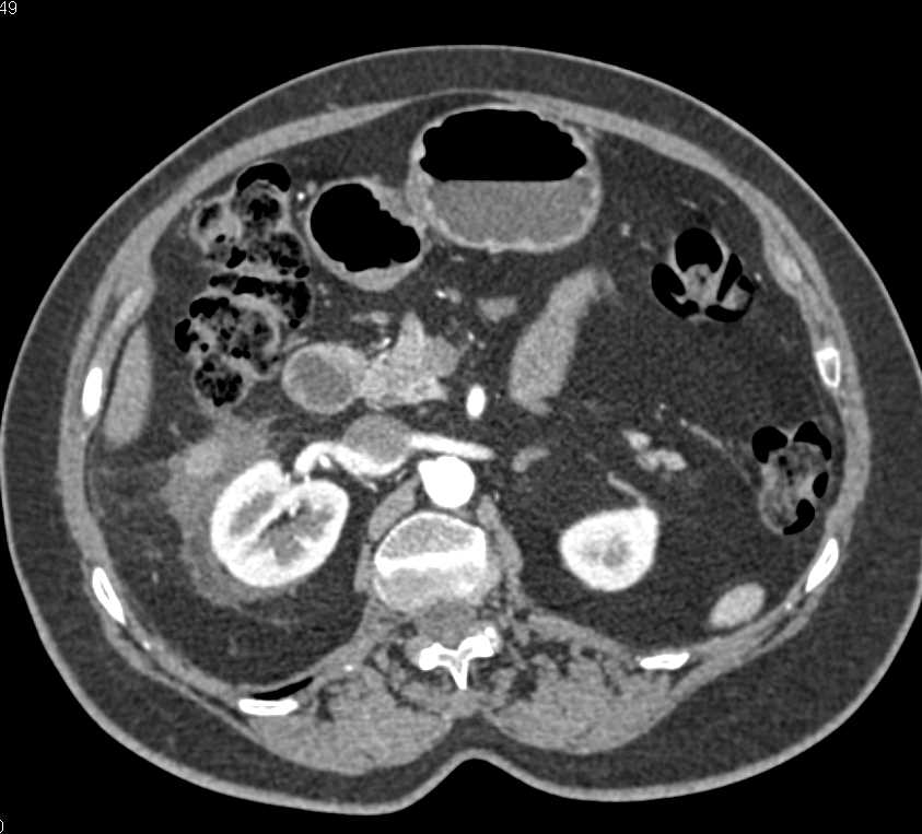 Right Perirenal Bleed - CTisus CT Scan