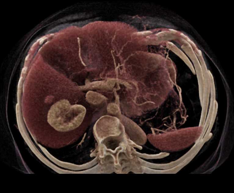 Right Perirenal Bleed - CTisus CT Scan