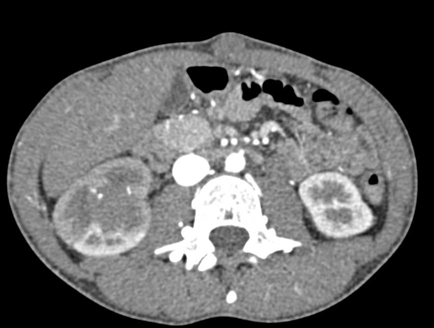 Metastatic Renal Cell Carcinoma - CTisus CT Scan