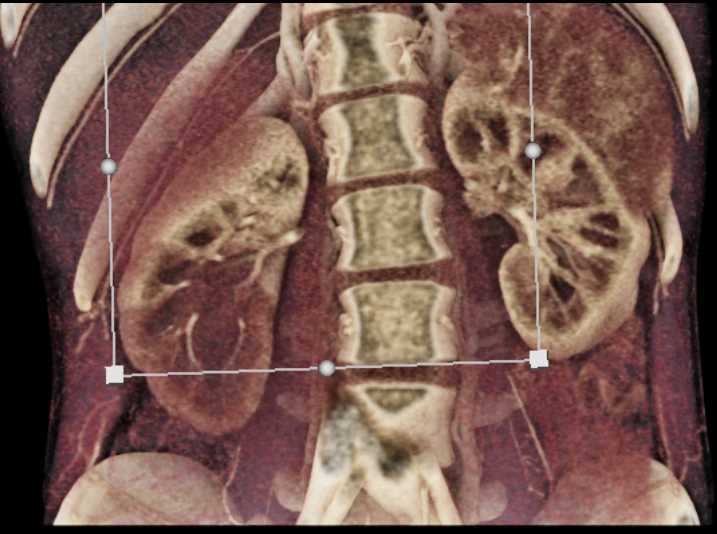 Metastatic Renal Cell Carcinoma - CTisus CT Scan