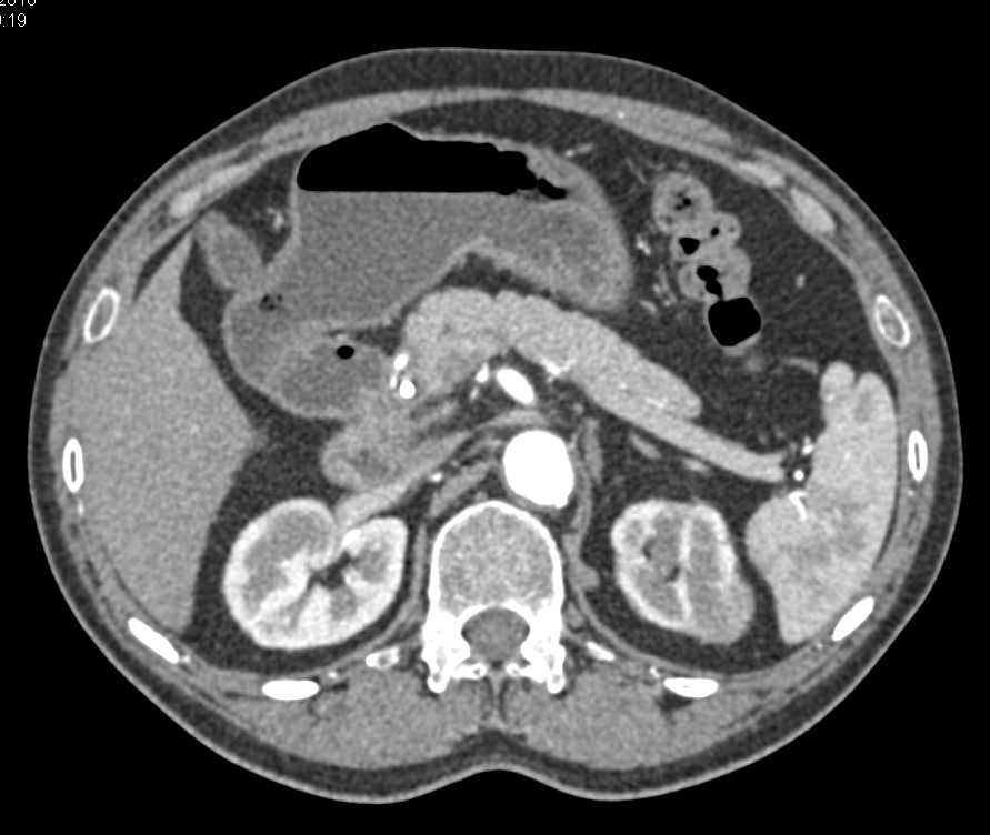 Subtle Lymphoma Left Kidney - CTisus CT Scan