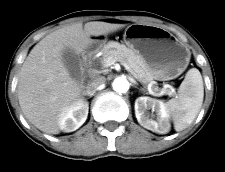 Subtle Lymphoma the Kidneys - CTisus CT Scan