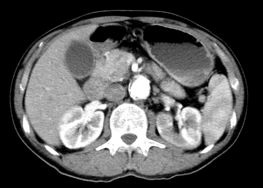IG4 Disease with Involvement of the Kidneys and Pancreas - CTisus CT Scan