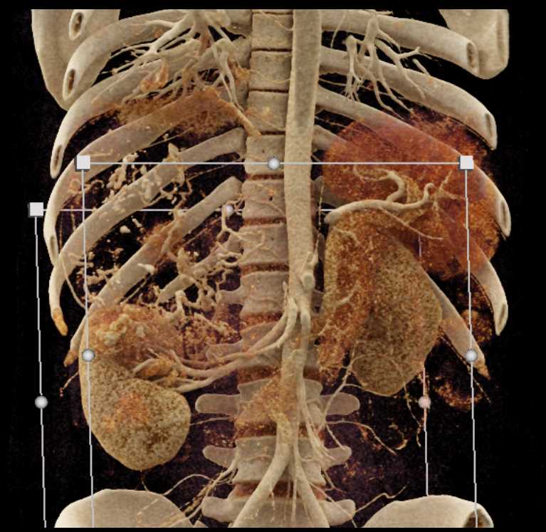 Extensive Neovascularity with Renal Cell Carcinoma - CTisus CT Scan
