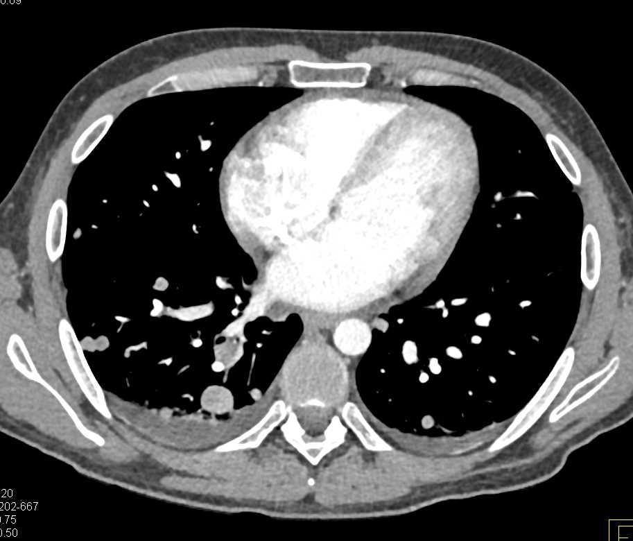 Extensive Neovascularity with Renal Cell Carcinoma and Metastases to Liver and Lung - CTisus CT Scan