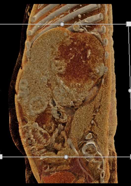 Extensive Neovascularity with Renal Cell Carcinoma and Metastases to Liver and Lung - CTisus CT Scan