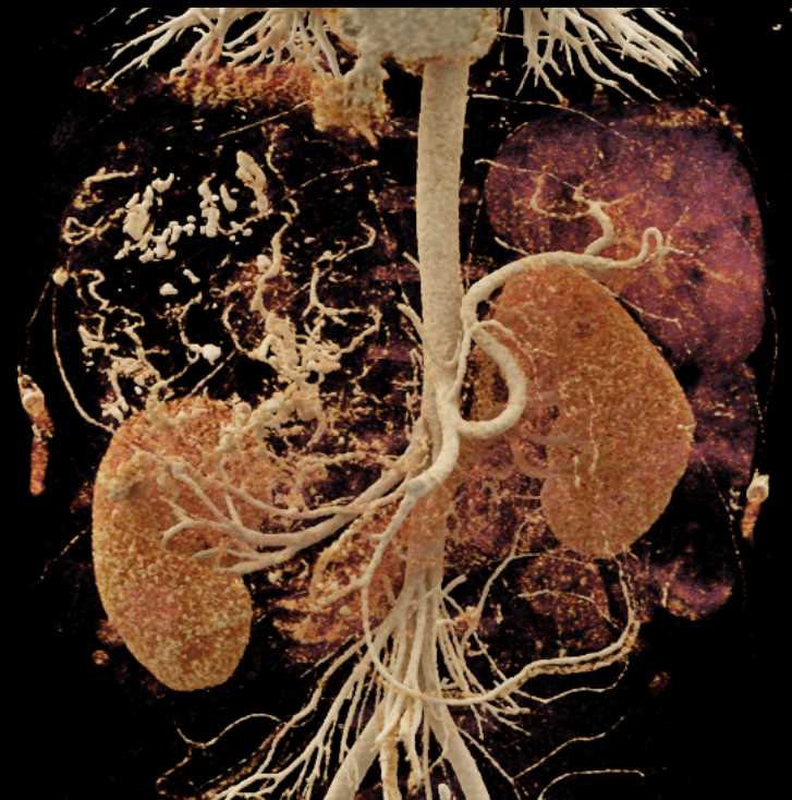 Extensive Neovascularity with Renal Cell Carcinoma and Metastases to Liver and Lung - CTisus CT Scan