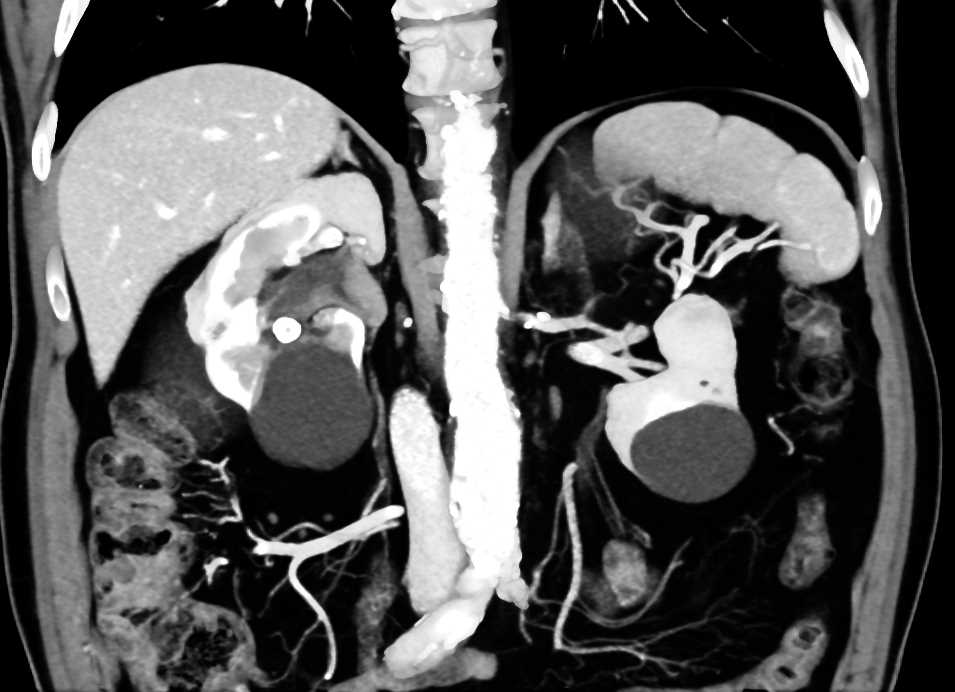 Transitional Cell Carcinoma Right Kidney and Bladder - CTisus CT Scan