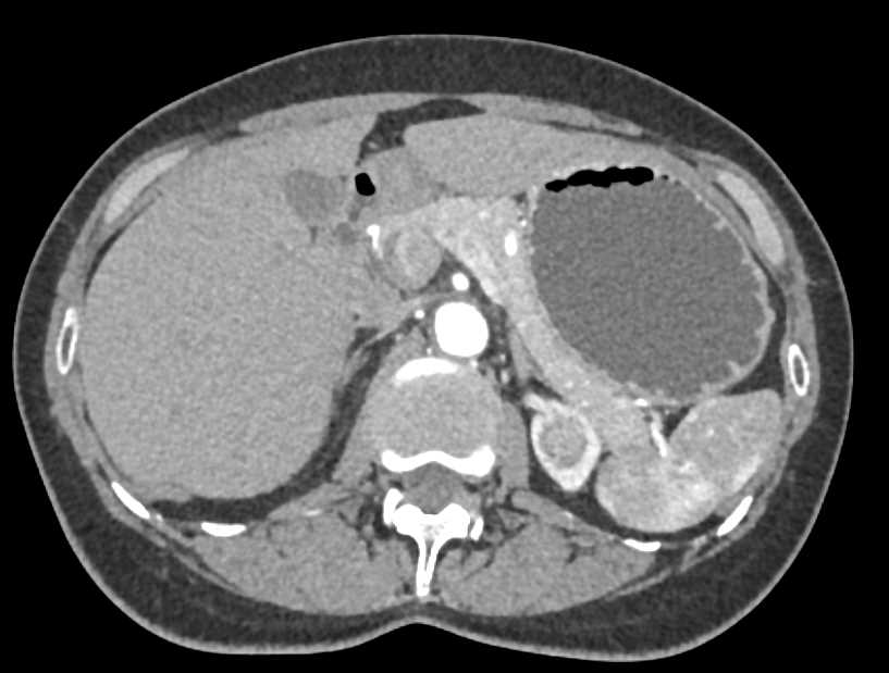 High Density Left Renal Cyst Upper Pole - CTisus CT Scan