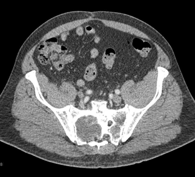 Metastatic RCC to Left Adrenal and Bone Especially Sacrum - CTisus CT Scan