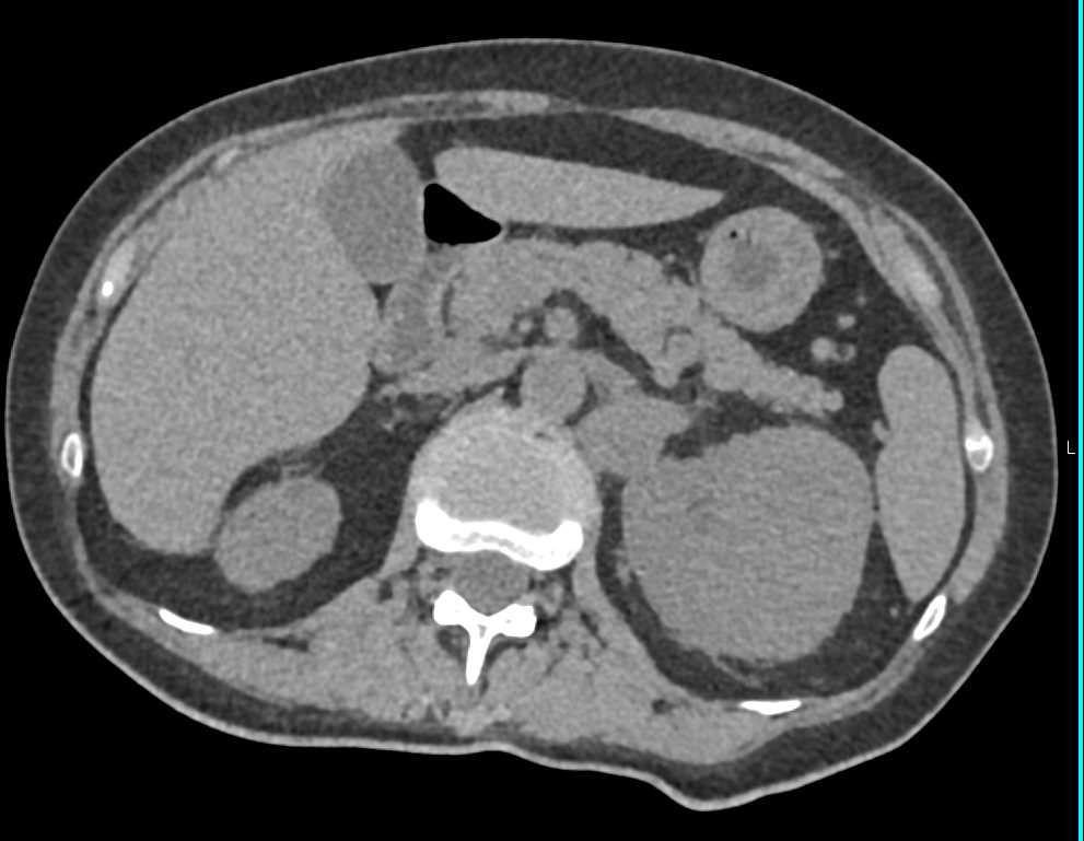 Clear Cell RCC with Adenopathy - CTisus CT Scan