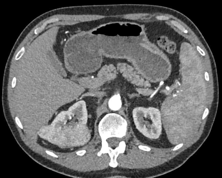 Clear Cell RCC - CTisus CT Scan