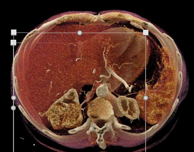 Clear Cell RCC - CTisus CT Scan