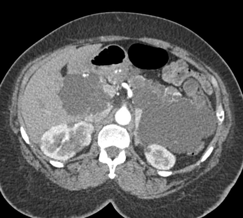 VHL with Renal and Pancreatic Cysts - CTisus CT Scan