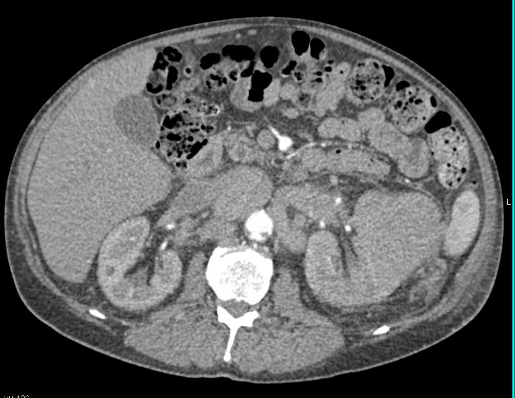 Renal Cell Carcinoma - CTisus CT Scan