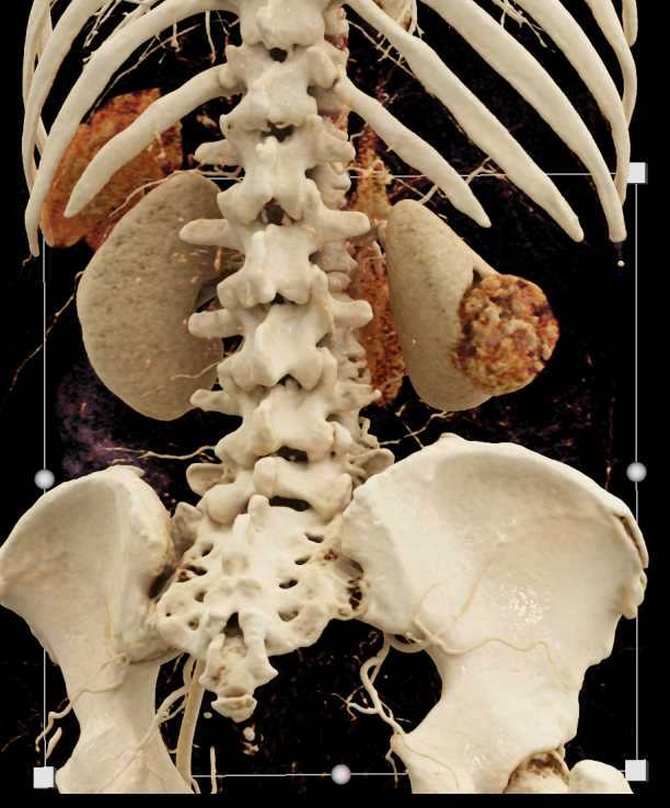 Clear Cell Renal Cell carcinoma - CTisus CT Scan