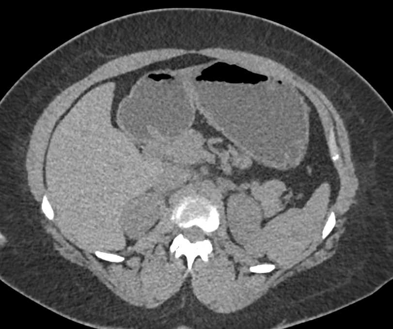 Papillary Left Renal Cell Carcinoma - CTisus CT Scan
