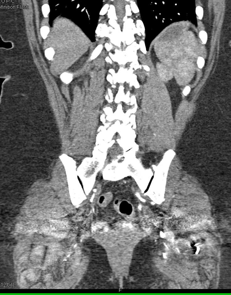 Papillary Left Renal Cell Carcinoma - CTisus CT Scan