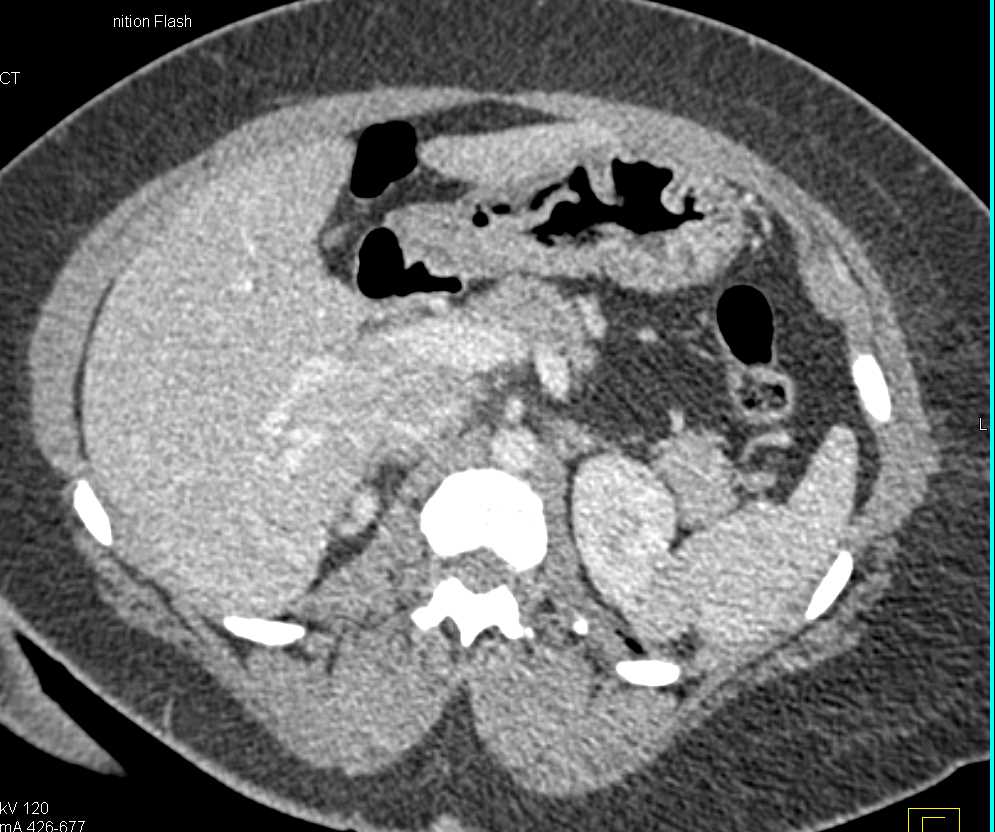 Papillary Renal Cell Carcinoma - CTisus CT Scan