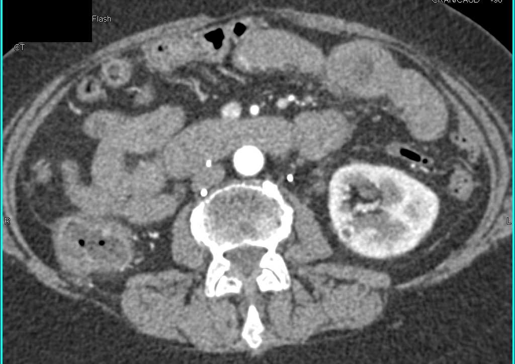5mm Metastases to the Left Kidney - CTisus CT Scan