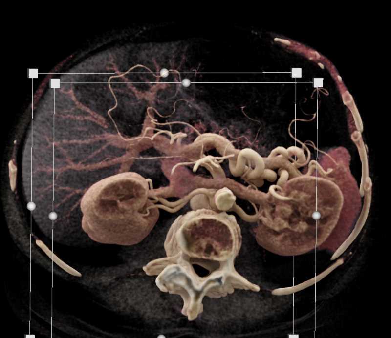 Renal Cell Carcinoma - CTisus CT Scan