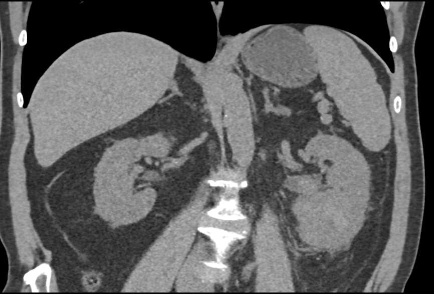 Clear Cell Renal Cell Carcinoma - CTisus CT Scan
