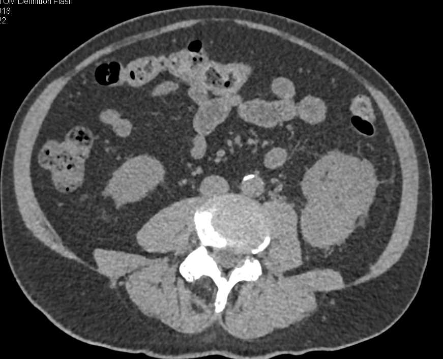 Transitional Cell Carcinoma Left Kidney - CTisus CT Scan