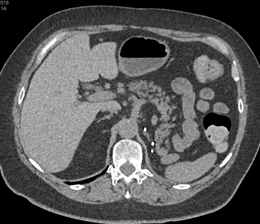 Metastatic Renal Cell Carcinoma to the Pancreas - CTisus CT Scan