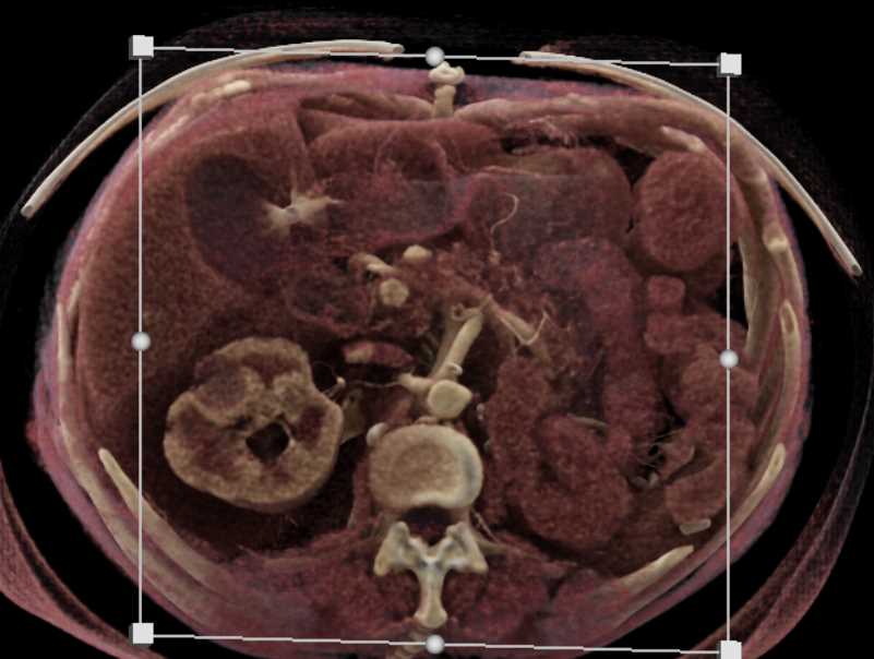 Metastatic Renal Cell Carcinoma to the Pancreas - CTisus CT Scan