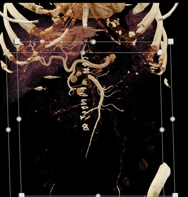 Metastatic Renal Cell Carcinoma to the Pancreas - CTisus CT Scan