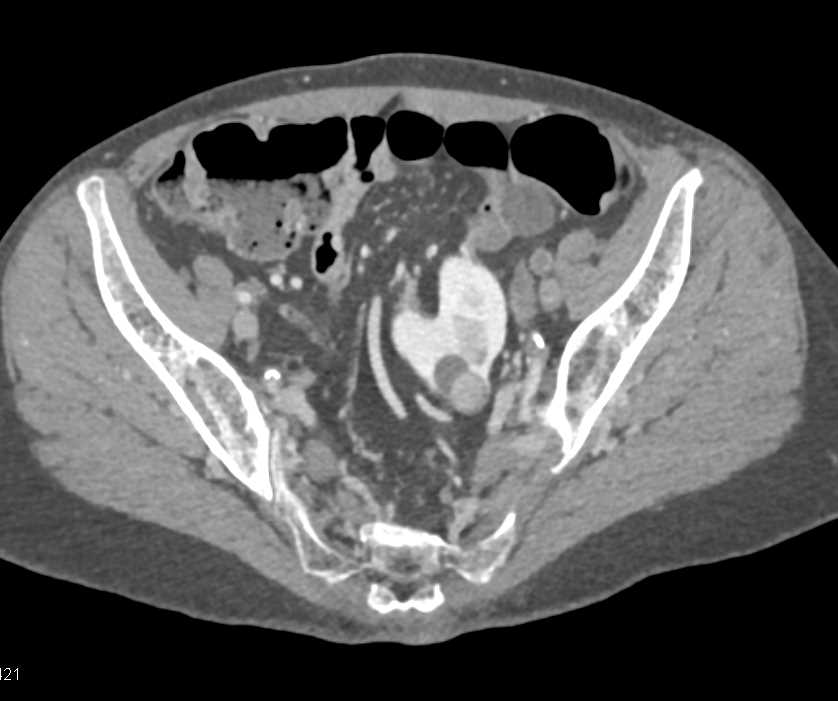 Renal Cell Carcinoma is a Solid Mass - CTisus CT Scan