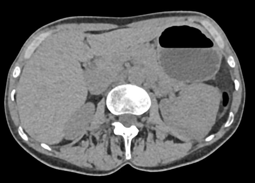 Left Renal Oncocytoma - CTisus CT Scan
