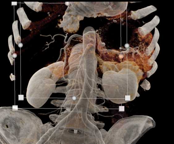 Left Renal Oncocytoma - CTisus CT Scan