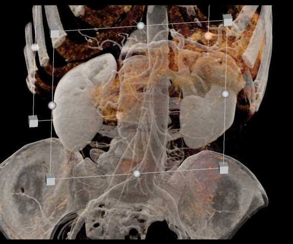 Left Renal Oncocytoma - CTisus CT Scan