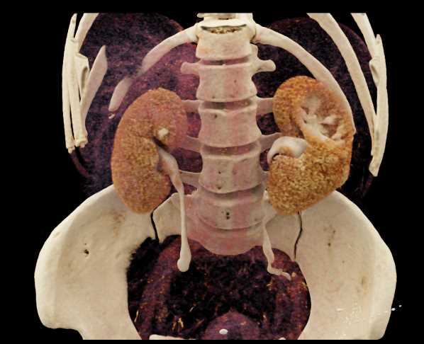 Left Renal Oncocytoma - CTisus CT Scan