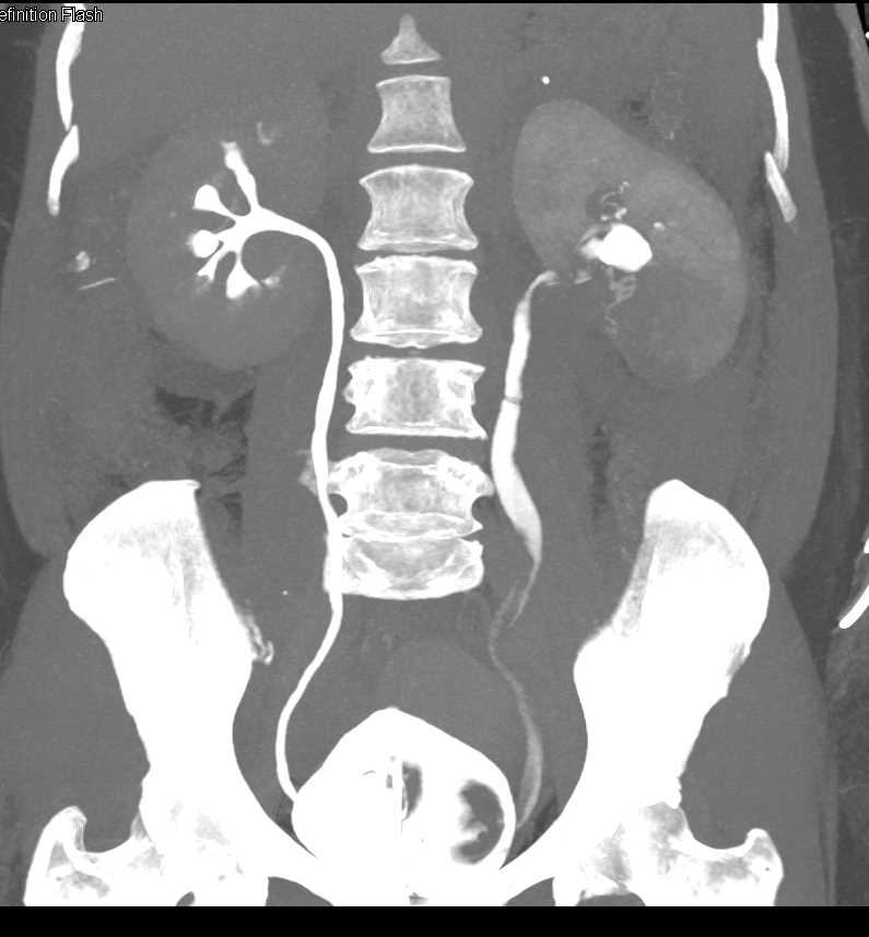 Transitional Cell Carcinoma Left Kidney - CTisus CT Scan