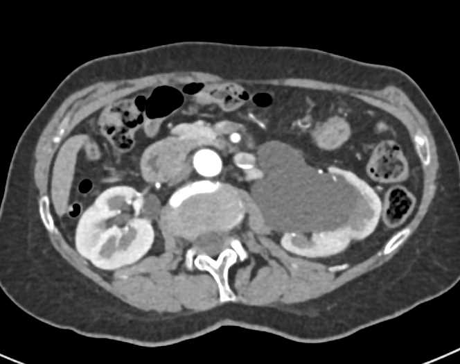 Parapelvic Cysts Left Kidney - CTisus CT Scan