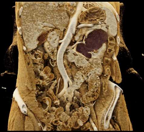 Parapelvic Cysts Left Kidney - CTisus CT Scan
