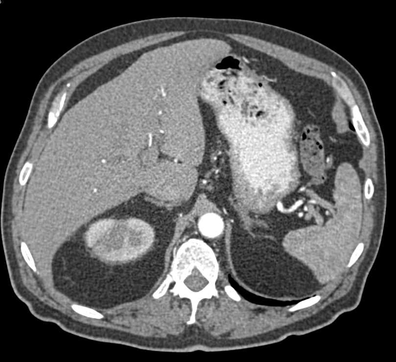 Acute Pyelonephritis Right Kidney - CTisus CT Scan