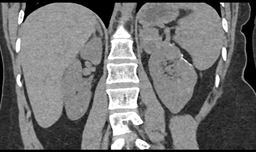 Renal Cell Carcinoma with Multiple Metastases - CTisus CT Scan