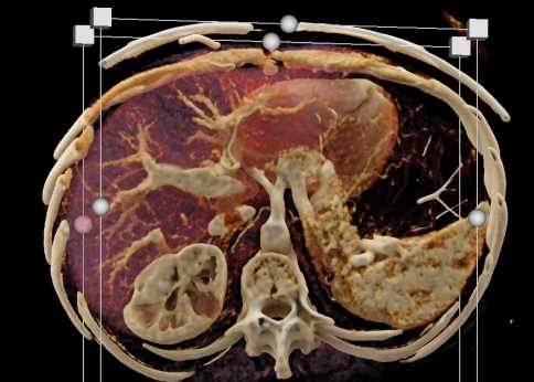 Renal Cell Carcinoma with Multiple Cystic Pancreatic Lesions - CTisus CT Scan