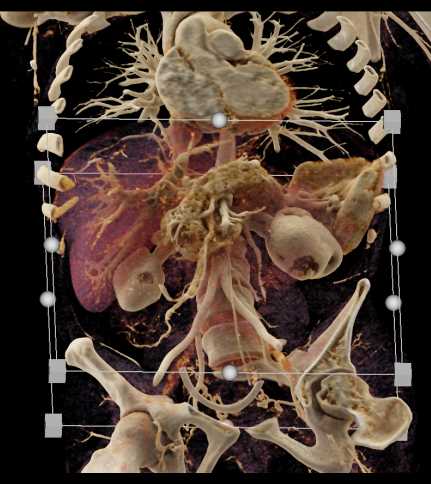 Renal Cell Carcinoma with Multiple Cystic Pancreatic Lesions - CTisus CT Scan