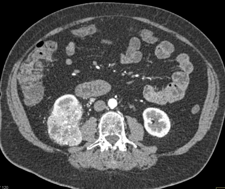 Clear Cell Renal Cell Carcinoma - CTisus CT Scan