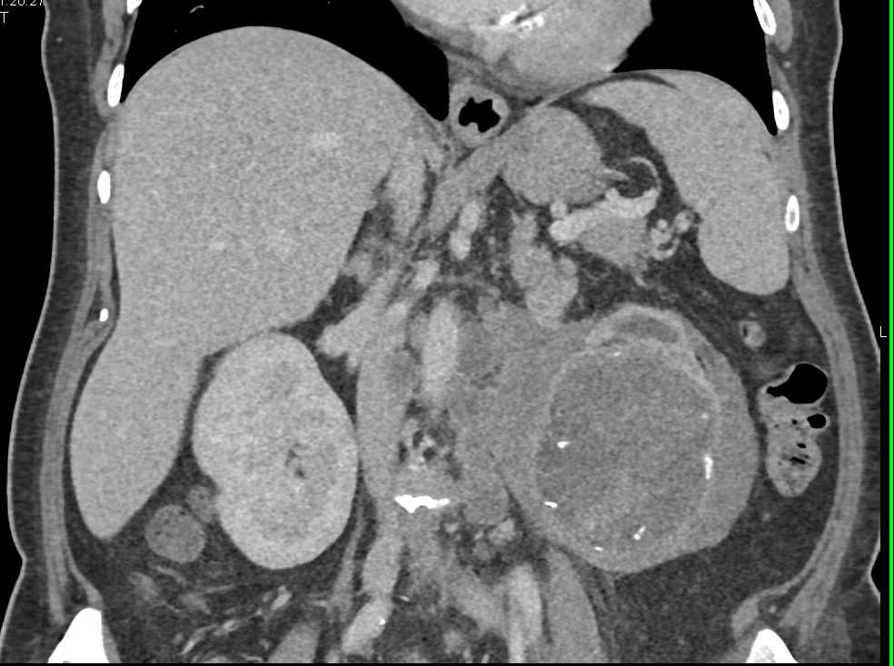 Renal Abscess Simulates a Tumor - CTisus CT Scan