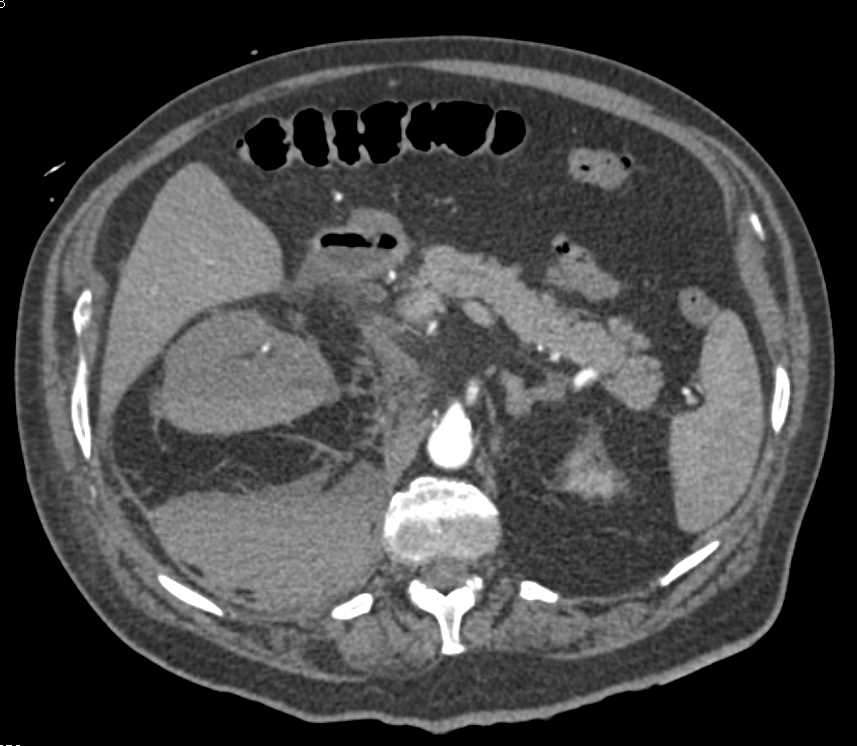Right Perirenal and Retroperitoneal Bleed - CTisus CT Scan